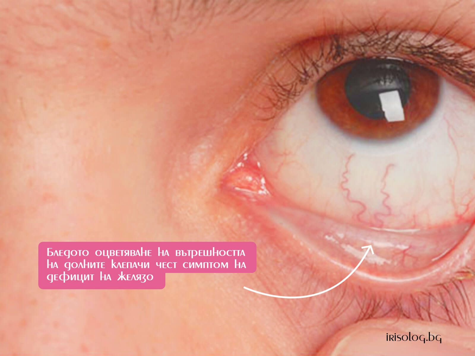 Бледото оцветяване на вътрешността на долните клепачи чест симптом на дефицит на желязо