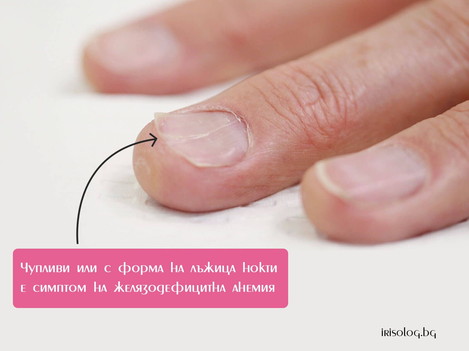 Чупливи или с форма на лъжица нокти е симптом на желязодефицитна анемия